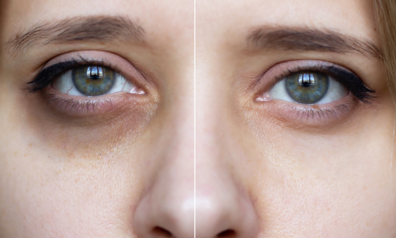 Do you know why you get dark circles under your eyes when you don’t get enough sleep?